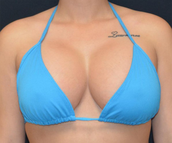 Example of Breast Augmentation before front angle view